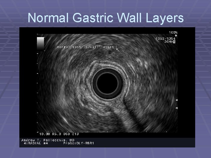 Normal Gastric Wall Layers 