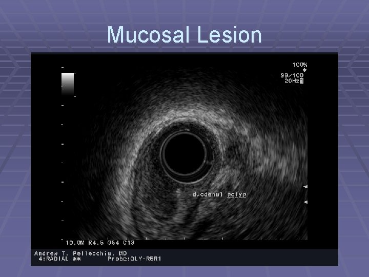 Mucosal Lesion 