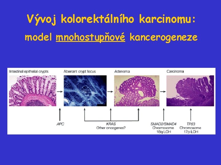 Vývoj kolorektálního karcinomu: model mnohostupňové kancerogeneze 