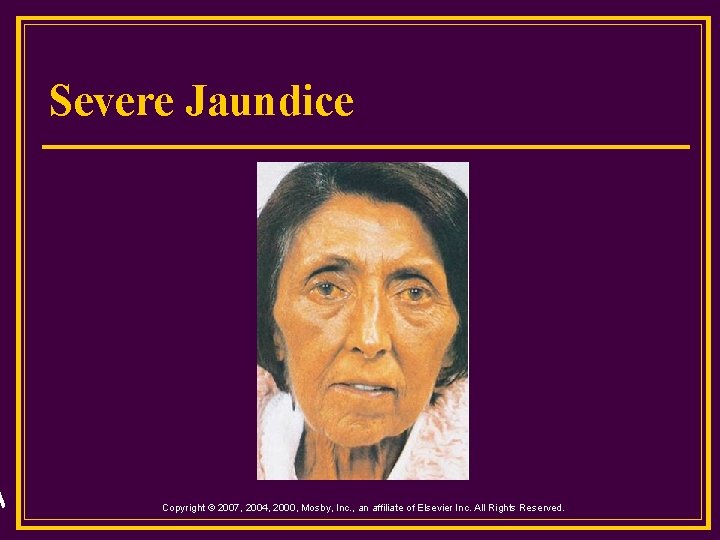 Severe Jaundice Copyright © 2007, 2004, 2000, Mosby, Inc. , an affiliate of Elsevier