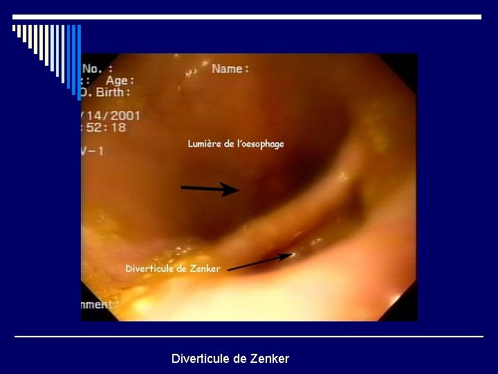 Diverticule de Zenker 