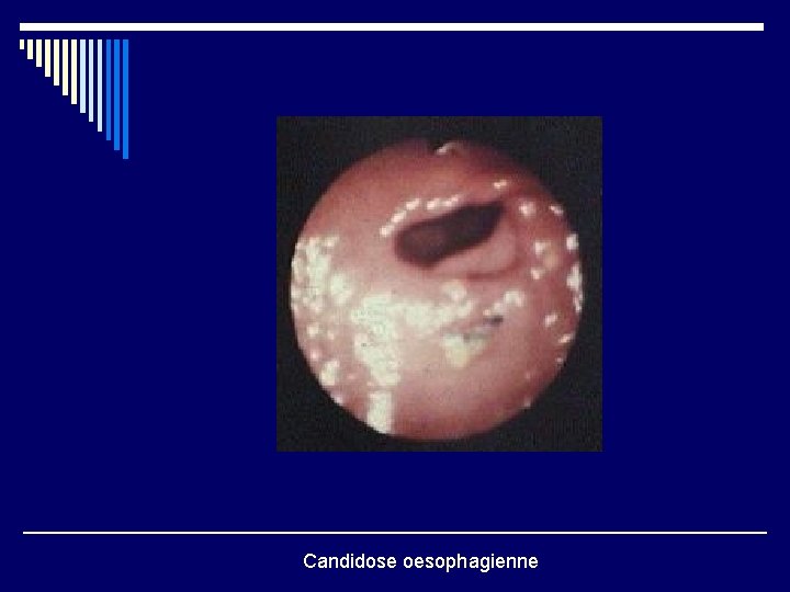 Candidose oesophagienne 