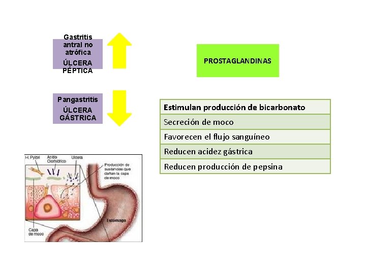 Gastritis antral no atrófica ÚLCERA PÉPTICA Pangastritis ÚLCERA GÁSTRICA PROSTAGLANDINAS Estimulan producción de bicarbonato