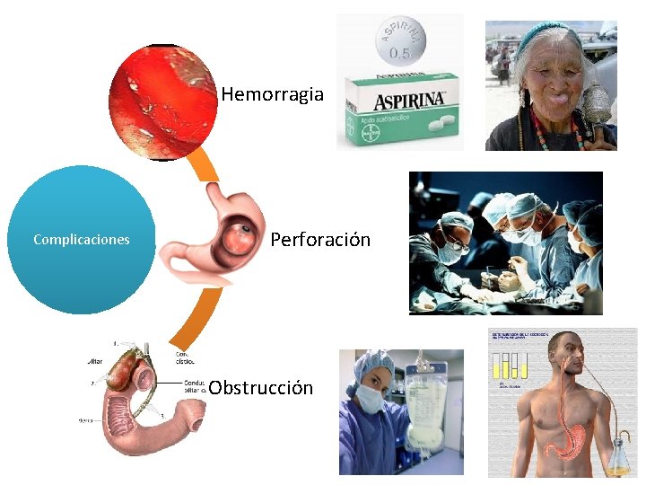 Hemorragia Complicaciones Perforación Obstrucción 