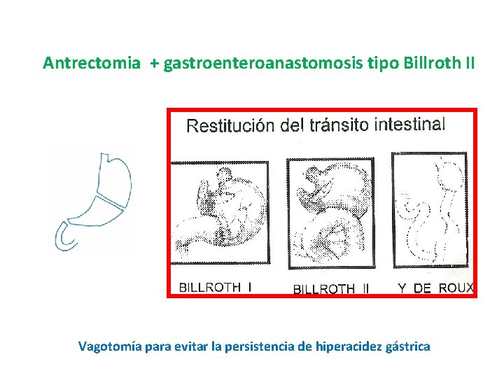 Antrectomia + gastroenteroanastomosis tipo Billroth II Vagotomía para evitar la persistencia de hiperacidez gástrica