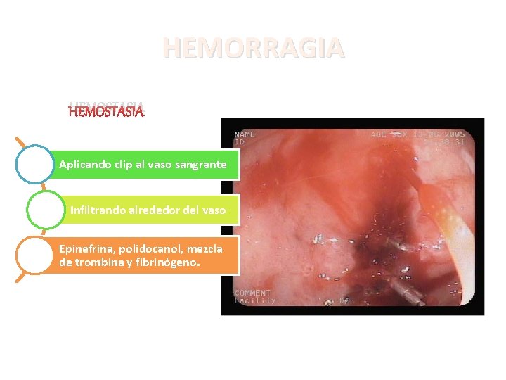 HEMORRAGIA HEMOSTASIA Aplicando clip al vaso sangrante Infiltrando alrededor del vaso Epinefrina, polidocanol, mezcla