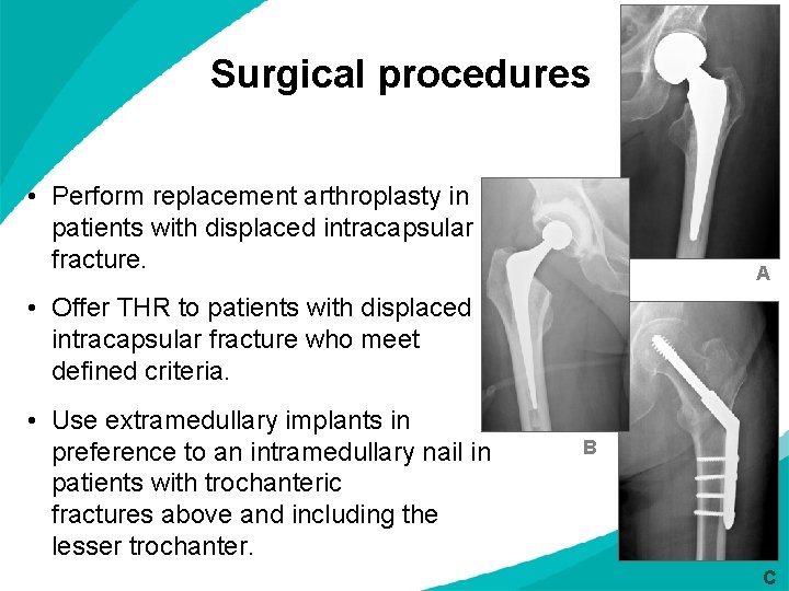 Surgical procedures • Perform replacement arthroplasty in patients with displaced intracapsular fracture. A •