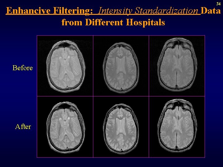 34 Enhancive Filtering: Intensity Standardization Data from Different Hospitals Before After 