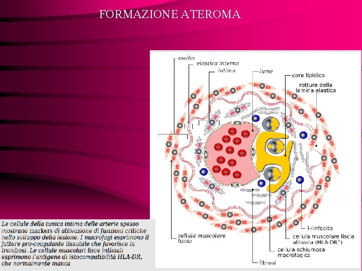 FORMAZIONE ATEROMA 