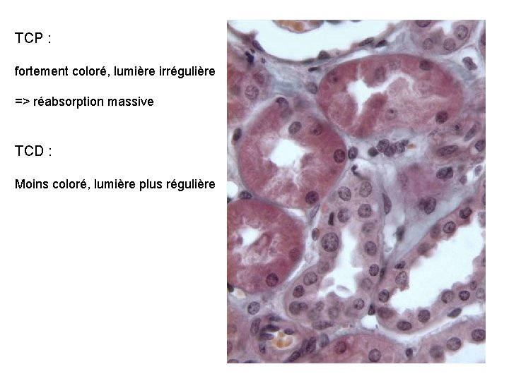 TCP : fortement coloré, lumière irrégulière => réabsorption massive TCD : Moins coloré, lumière