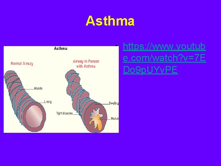 Asthma • https: //www. youtub e. com/watch? v=7 E Do 9 p. UYv. PE