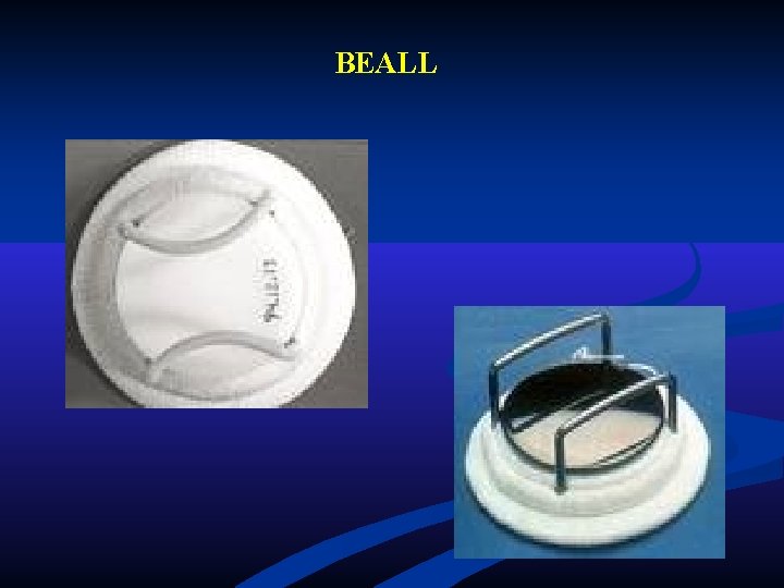 BEALL BEALL