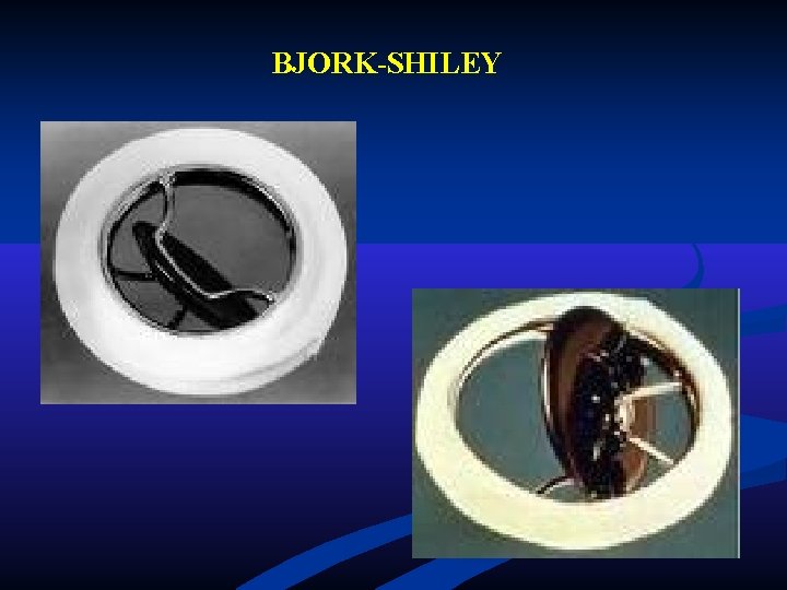 BJORK-SHILEY BJORK-SHILEY