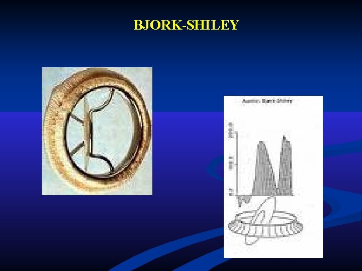 BJORK-SHILEY BJORK-SHILEY
