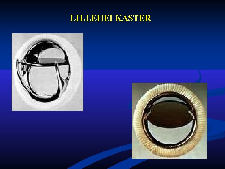 LILLEHEI KASTER LILLEHEI KASTER