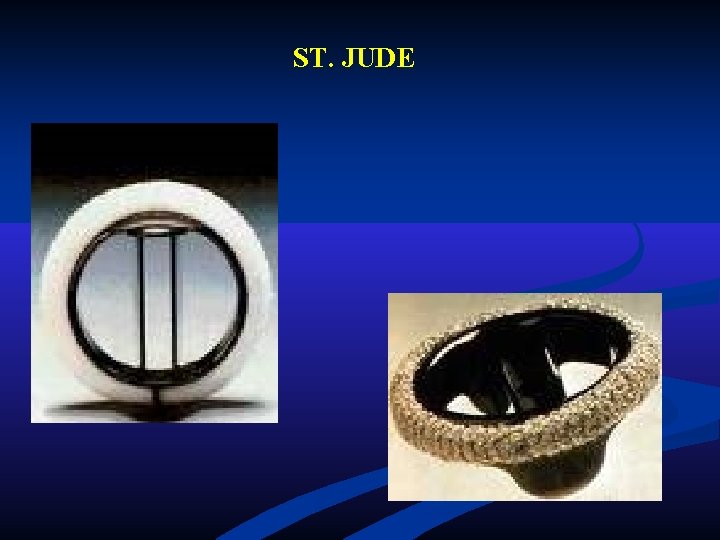 ST. JUDE ST. JUDE