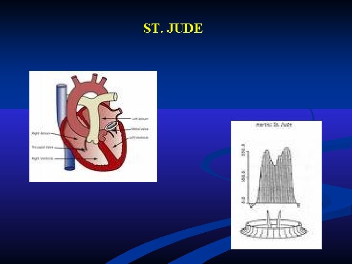 ST. JUDE ST. JUDE