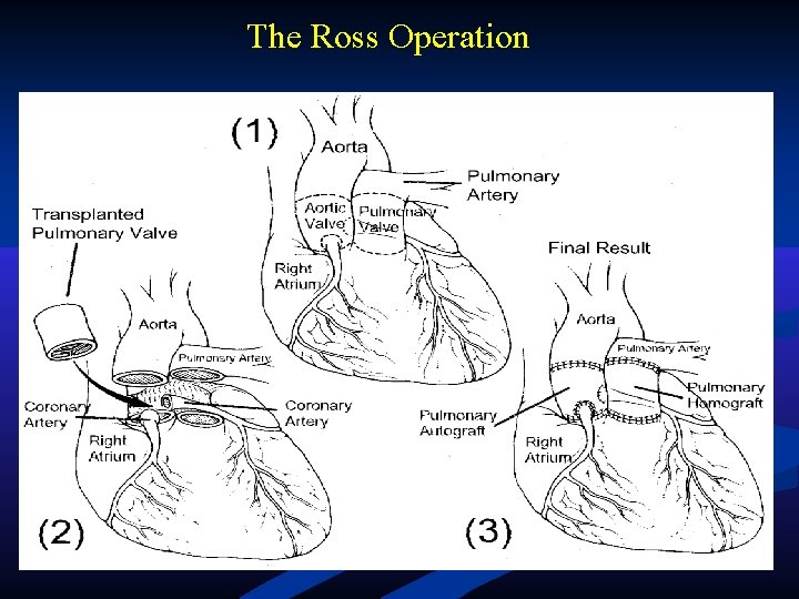 The Ross Operation The Ross Operation