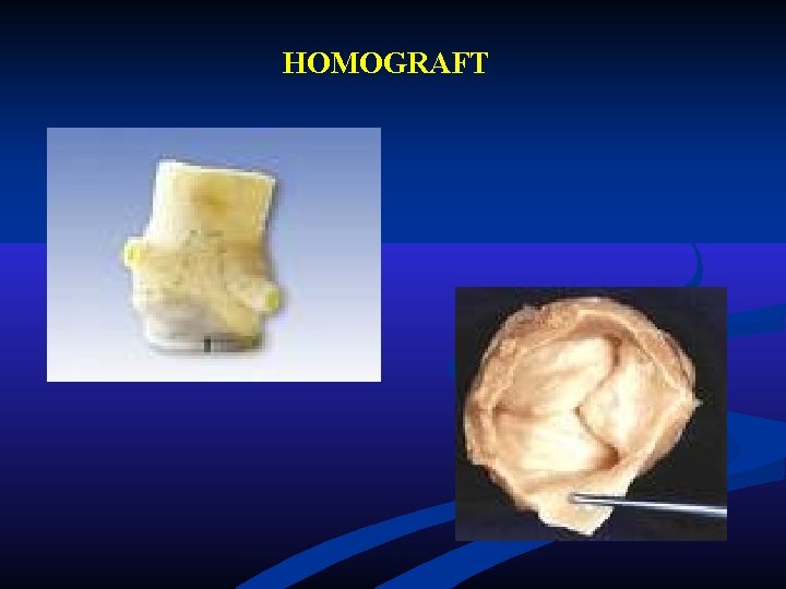 HOMOGRAFT HOMOGRAFT