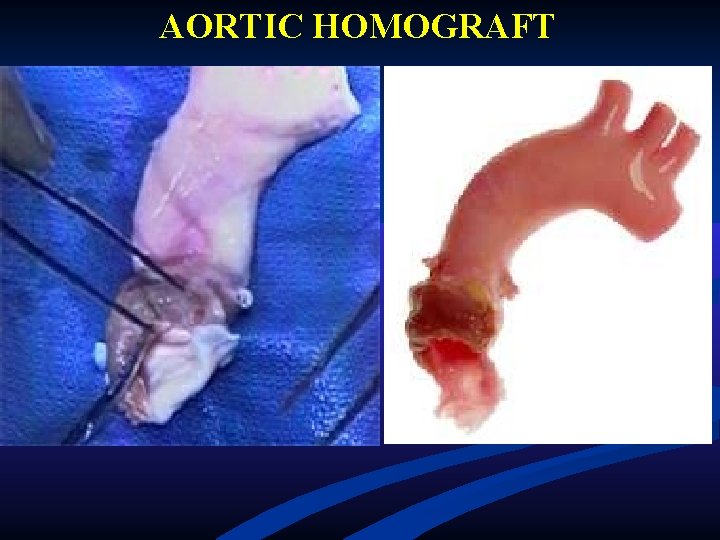 AORTIC HOMOGRAFT AORTIC HOMOGRAFT