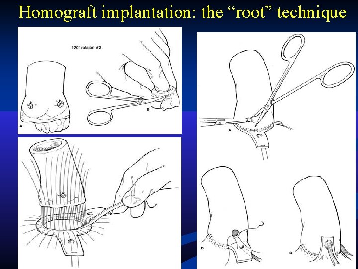 Homograft implantation: the “root” technique Homograft implantation: the “root” technique