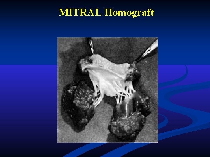 MITRAL Homograft MITRAL Homograft