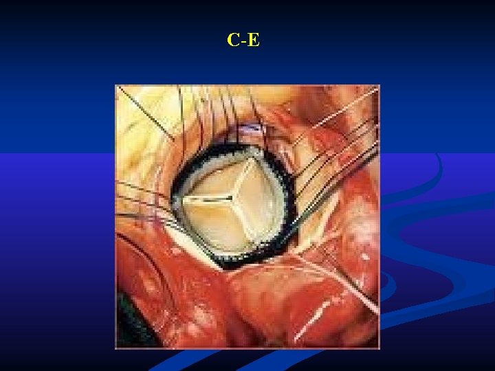 C-E C-E
