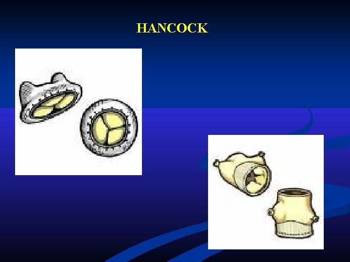 HANCOCK HANCOCK