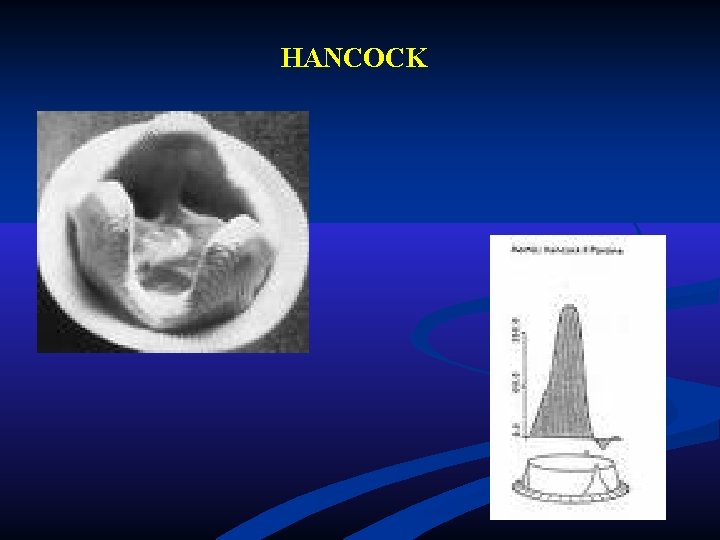 HANCOCK HANCOCK