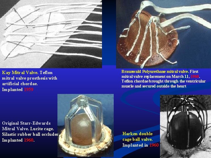 Kay Mitral Valve. Teflon mitral valve prosthesis with artificial chordae. Implanted 1959 Original Starr-Edwards Kay Mitral Valve. Teflon mitral valve prosthesis with artificial chordae. Implanted 1959 Original Starr-Edwards