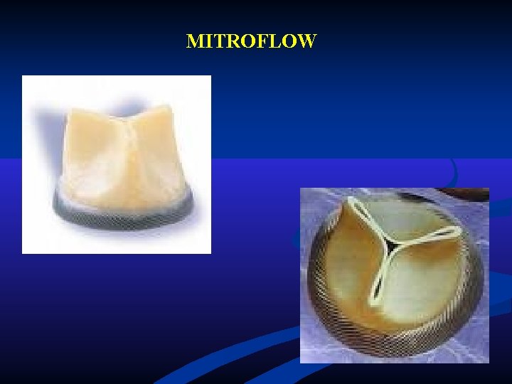 MITROFLOW MITROFLOW