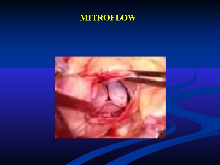 MITROFLOW MITROFLOW