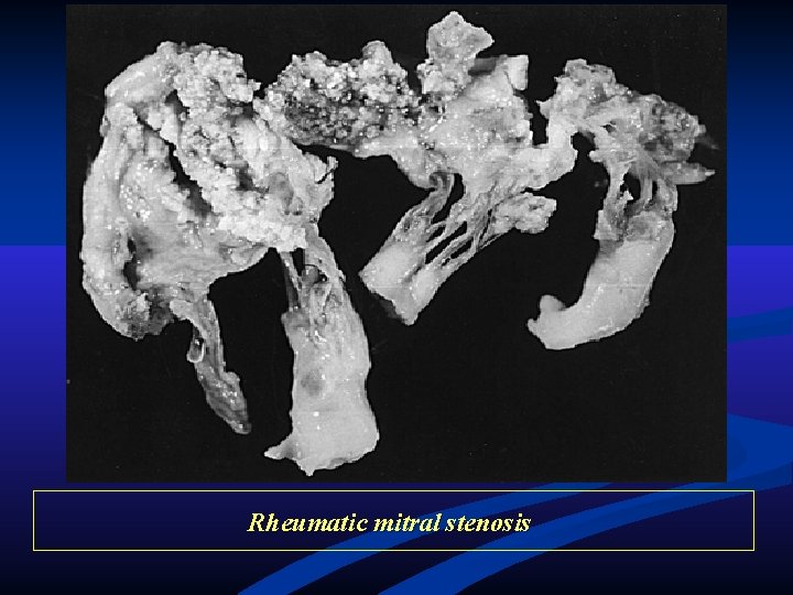 Rheumatic mitral stenosis Rheumatic mitral stenosis