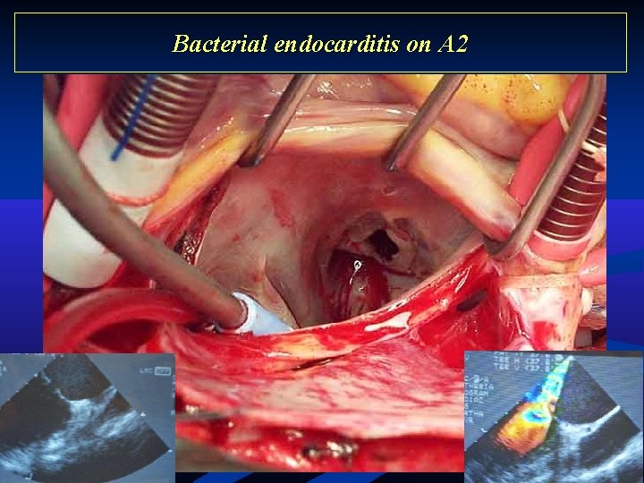 Bacterial endocarditis on A 2 Bacterial endocarditis on A 2