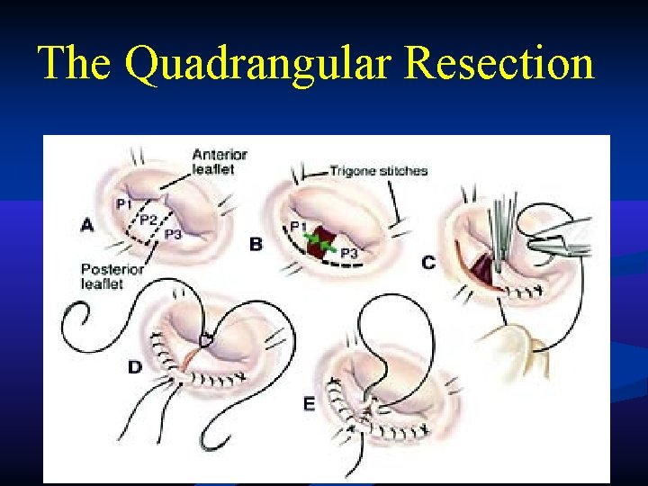 The Quadrangular Resection The Quadrangular Resection