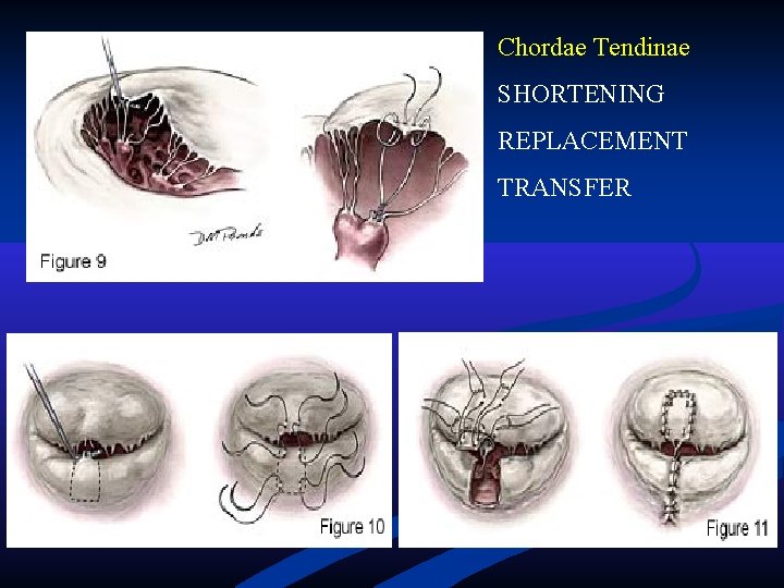 Chordae Tendinae SHORTENING REPLACEMENT TRANSFER Chordae Tendinae SHORTENING REPLACEMENT TRANSFER