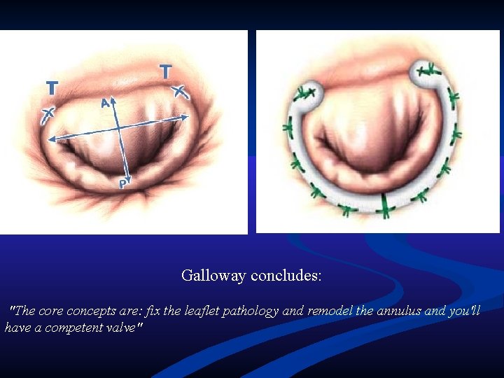 Galloway concludes: "The core concepts are: fix the leaflet pathology and remodel the annulus Galloway concludes: "The core concepts are: fix the leaflet pathology and remodel the annulus