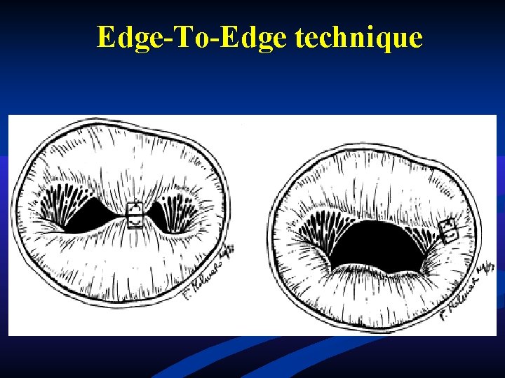 Edge-To-Edge technique Edge-To-Edge technique