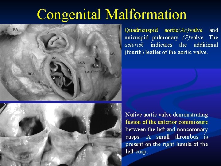 Congenital Malformation Quadricuspid aortic(Ao)valve and unicuspid pulmonary (P)valve. The asterisk indicates the additional (fourth) Congenital Malformation Quadricuspid aortic(Ao)valve and unicuspid pulmonary (P)valve. The asterisk indicates the additional (fourth)