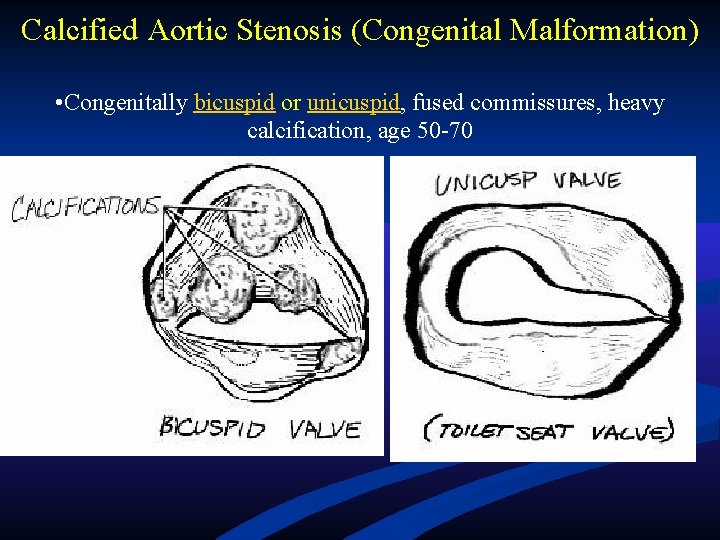 Calcified Aortic Stenosis (Congenital Malformation) • Congenitally bicuspid or unicuspid, fused commissures, heavy calcification, Calcified Aortic Stenosis (Congenital Malformation) • Congenitally bicuspid or unicuspid, fused commissures, heavy calcification,