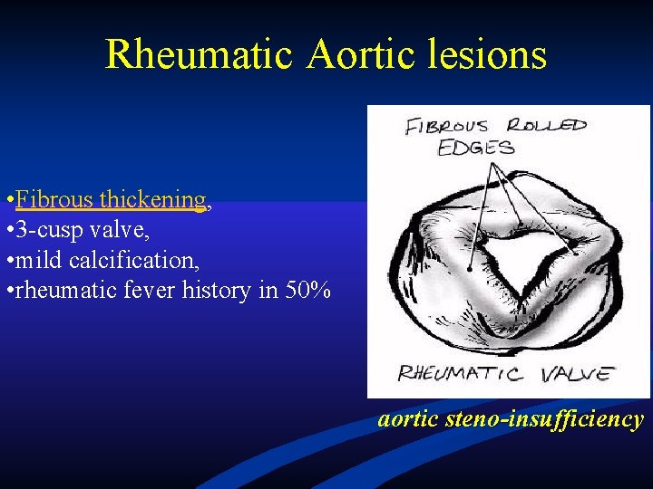 Rheumatic Aortic lesions • Fibrous thickening, • 3 -cusp valve, • mild calcification, • Rheumatic Aortic lesions • Fibrous thickening, • 3 -cusp valve, • mild calcification, •
