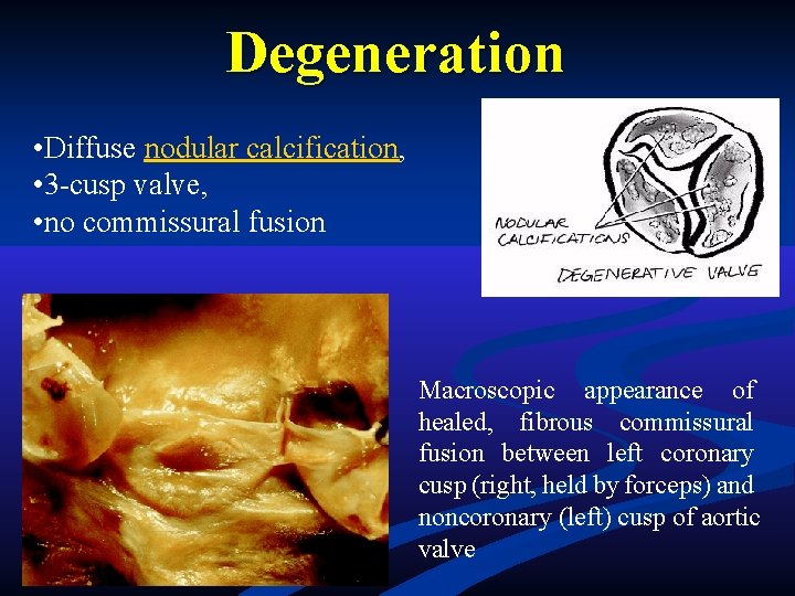 Degeneration • Diffuse nodular calcification, • 3 -cusp valve, • no commissural fusion Macroscopic Degeneration • Diffuse nodular calcification, • 3 -cusp valve, • no commissural fusion Macroscopic