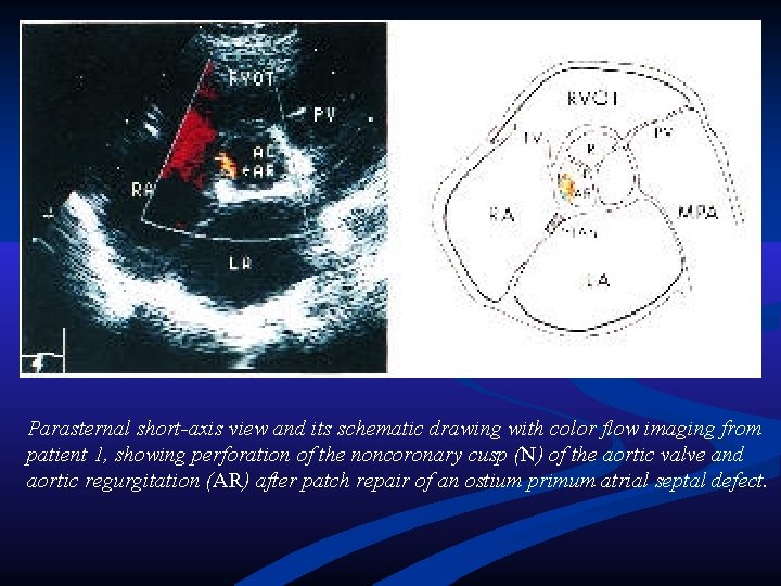 Parasternal short-axis view and its schematic drawing with color flow imaging from patient 1, Parasternal short-axis view and its schematic drawing with color flow imaging from patient 1,