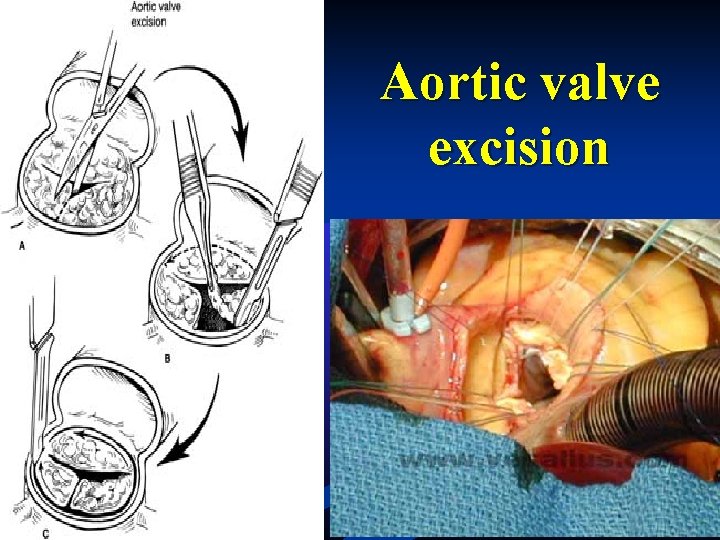 Aortic valve excision Aortic valve excision