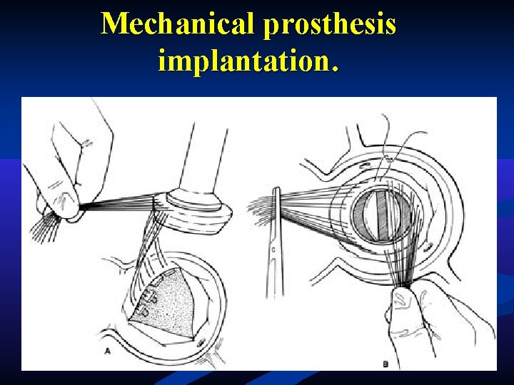 Mechanical prosthesis implantation. Mechanical prosthesis implantation.