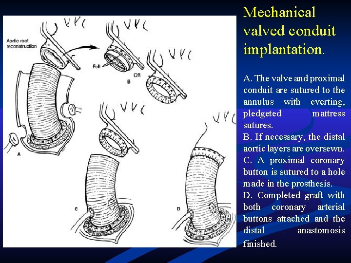 Mechanical valved conduit implantation. A. The valve and proximal conduit are sutured to the Mechanical valved conduit implantation. A. The valve and proximal conduit are sutured to the