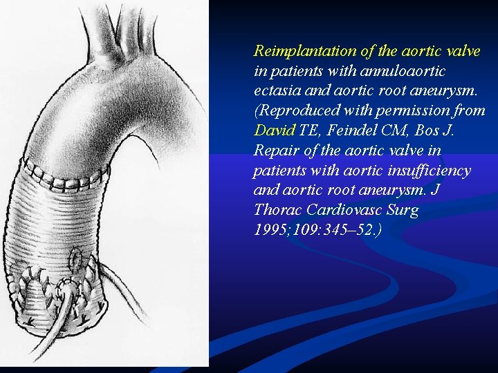 Reimplantation of the aortic valve in patients with annuloaortic ectasia and aortic root aneurysm. Reimplantation of the aortic valve in patients with annuloaortic ectasia and aortic root aneurysm.