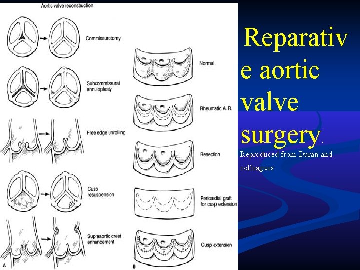 Reparativ e aortic valve surgery. Reproduced from Duran and colleagues Reparativ e aortic valve surgery. Reproduced from Duran and colleagues