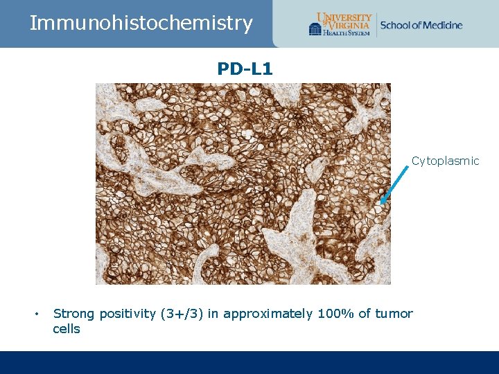 Immunohistochemistry PD-L 1 Cytoplasmic • Strong positivity (3+/3) in approximately 100% of tumor cells