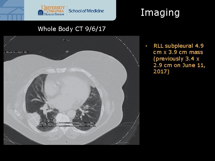 Imaging Whole Body CT 9/6/17 • RLL subpleural 4. 9 cm x 3. 9